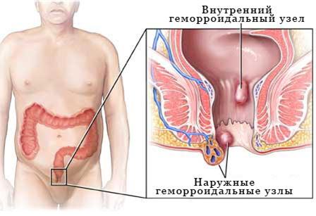 "Геморрой"